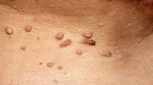 Acrocordones en el cuello