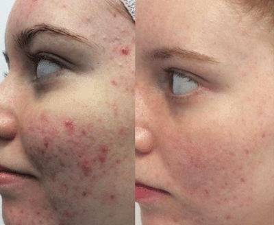 Resultados de un tratamiento de microdermabrasión.