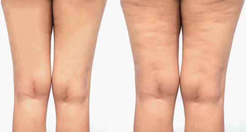 celulitis en las piernas