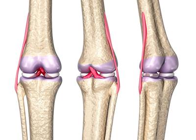 3 etapas de inicio de la osteoartritis